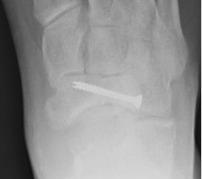 Navicular ORIF Union